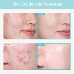 SOS Repair CICA Clinic Zinc Cream, 100,000ppm Zinc Oxide, Heal, Soothe Acne, Red