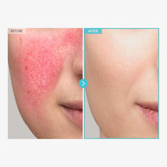 SOS Repair CICA Clinic Zinc Cream, 100,000ppm Zinc Oxide, Heal, Soothe Acne, Red